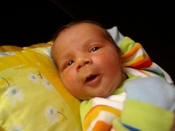 Anne Sütü Sarılığı Belirtileri 